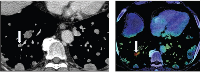 59-year-old man with renal cancer and multiple lung metastases who underwent conventional contrast-enhanced chest CT