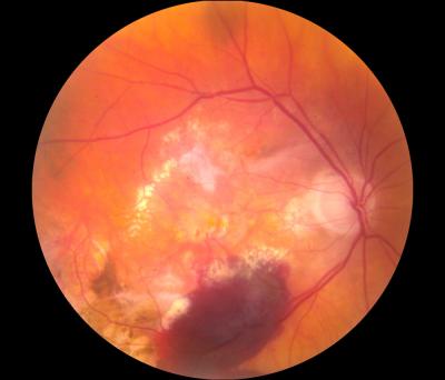 Wet Macular Degeneration