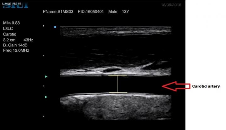 Ultrasound Image of the Carotid Artery