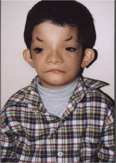 Full Facial Photograph of Individual with Hamamy Syndrome
