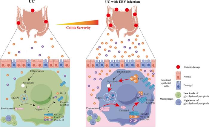 EBV Infection Aggravates Ulcerative Colitis via Glycolysis-Driven Macrophage Pyroptosist.