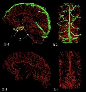 3-D rendering from high resolution black blood MRI