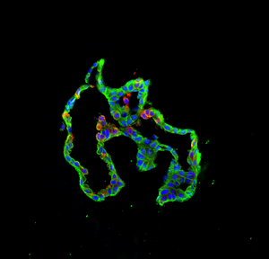 Cultured Kras-mutant airway club cells (labeled in green) express alveolar cell markers (red), demonstrating plasticity imparted to airway club cells by Kras-mutation mechanisms.