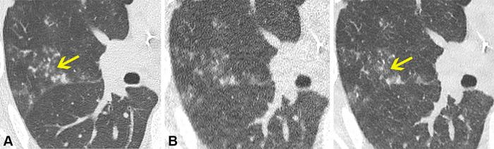 Noncontrast chest CT lung window images in a 70-year-old male participant