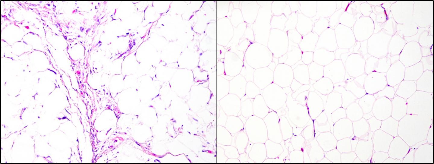 New test provides fast and accurate diagnosis of liposarcomas