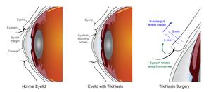 Trichiasis surgery