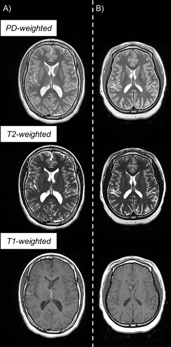 cerebral palsy brain scan comparison