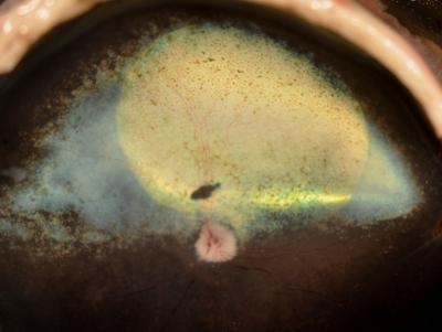 Second Dose of Gene Therapy for Inherited Blindness