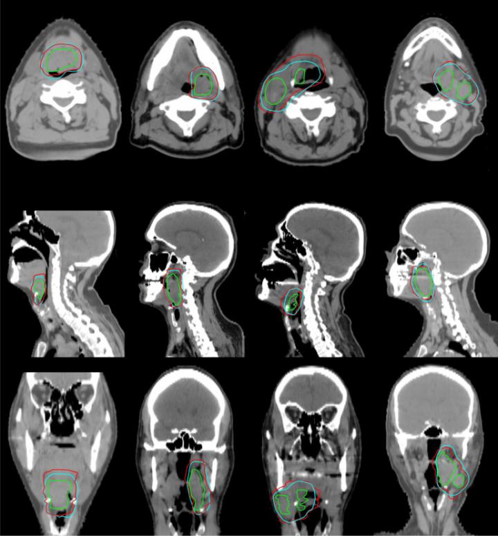 Comparison between Computer-Predicted Clinical Target Volume and Manual Contours