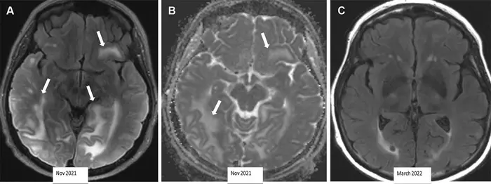 Severe ARIA-E (edema) in a 69-year-old woman receiving aducanumab therapy for AD with headaches and word-finding difficulty.