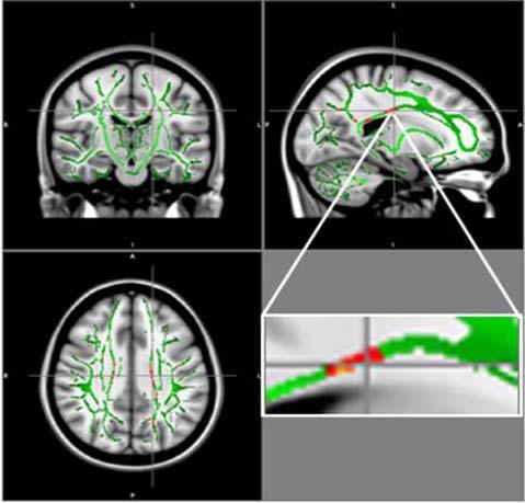 MRI Reveals Brain Damage in Obese Teens