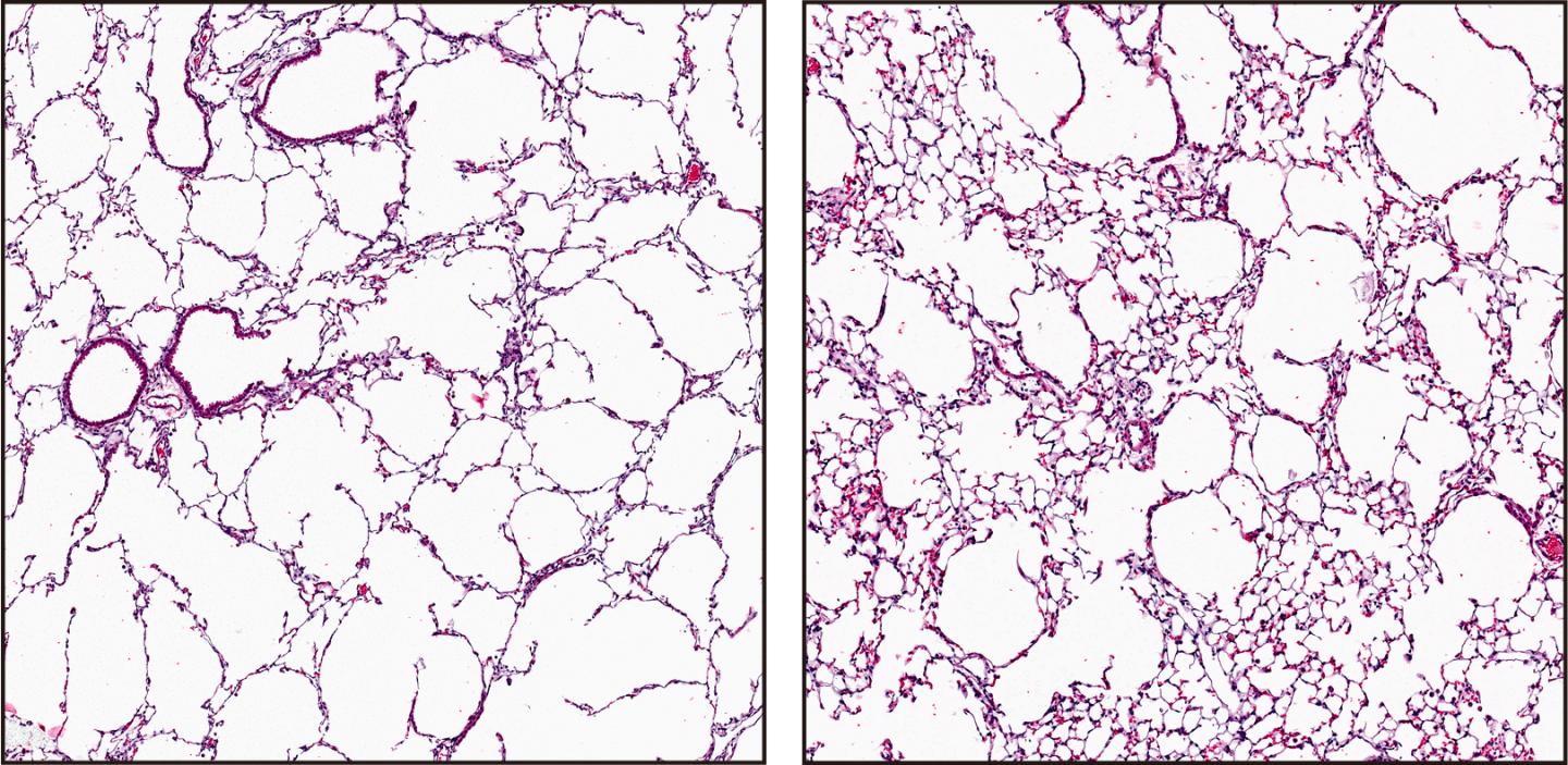 emphysema lung vs normal lung