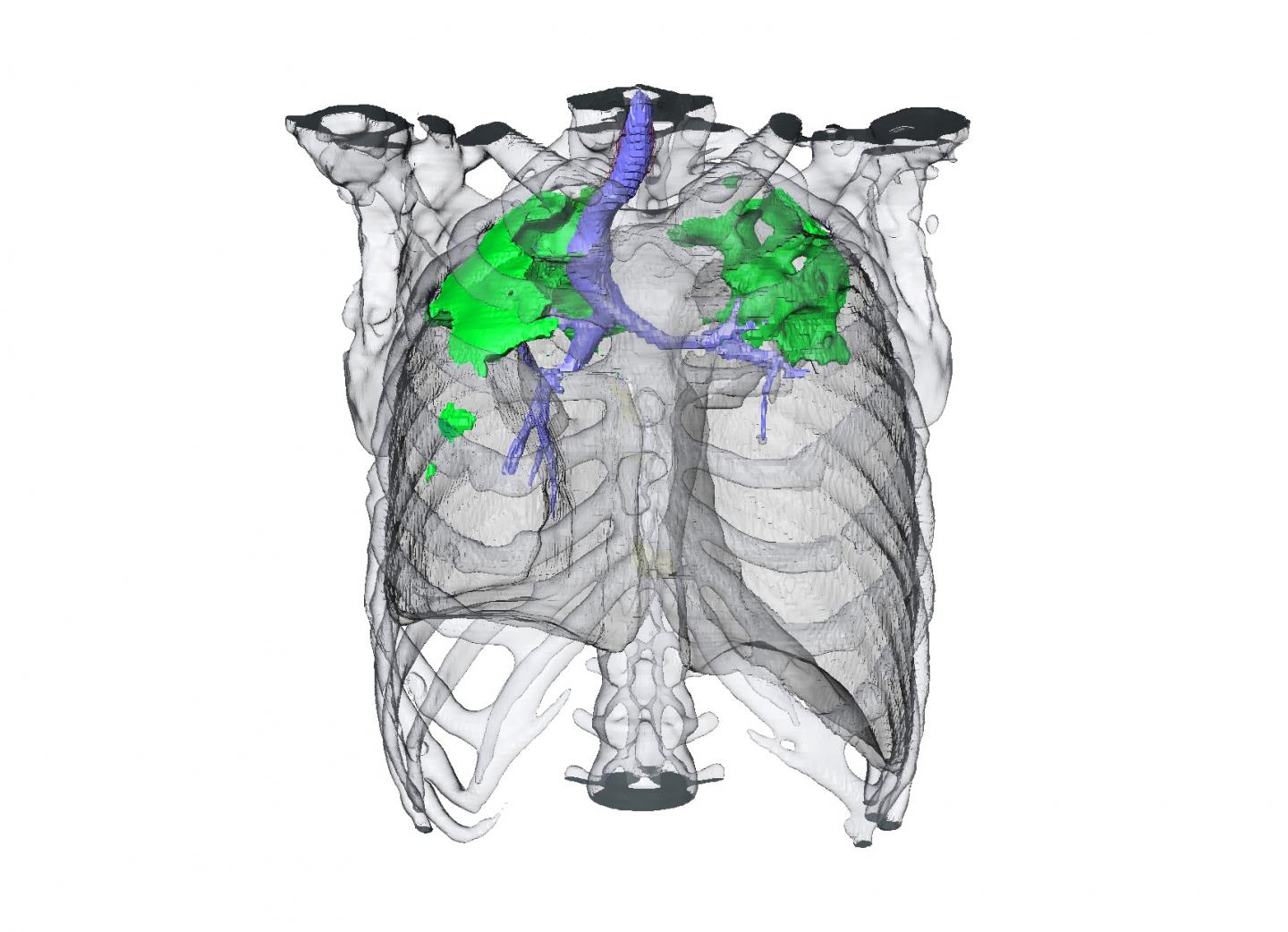 TB Patient's Response to An Antibiotic Drug Regimen