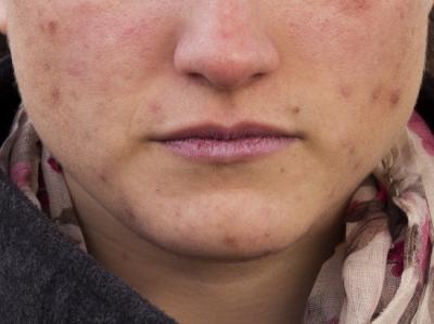 Girl Suffering from Moderate Acne