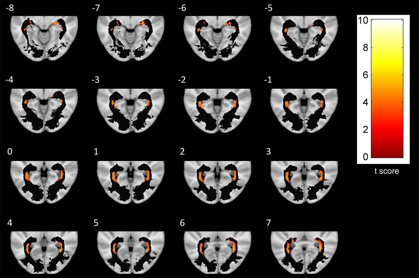 Figure 3 A Series of Axial-Section Images Show White Matter