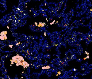 COVID negative lung