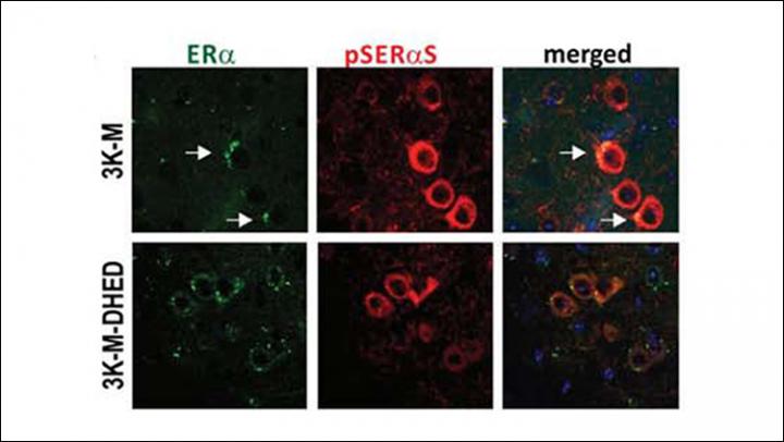 Estrogen Improves Parkinson's Disease Symptoms