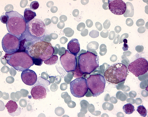 Leukemic blasts