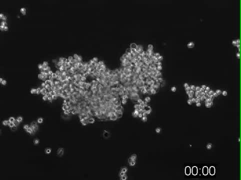 Human brain cancer cells forming spherical structures