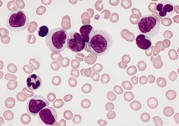 Histological View of Leukemia Cells