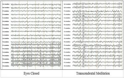Comparative EEG Tracings