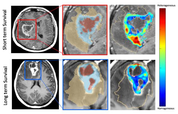 Glioblastoma MRI Images