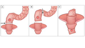 2. Main surgical procedures of specimen extraction in resection-extraction technique of transanal and transvaginal NOSES.
