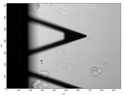 Squeezing Cancer Cells (2 of 2)