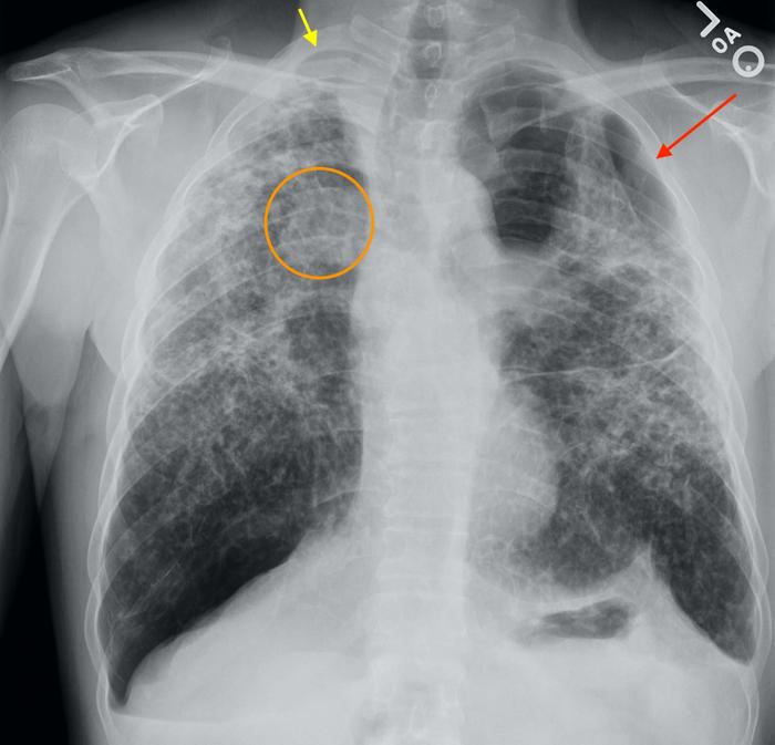 Chest X-ray