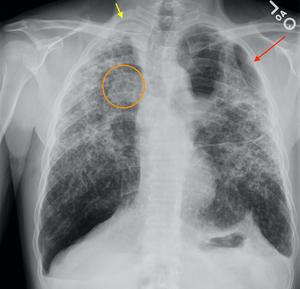 Chest X-ray