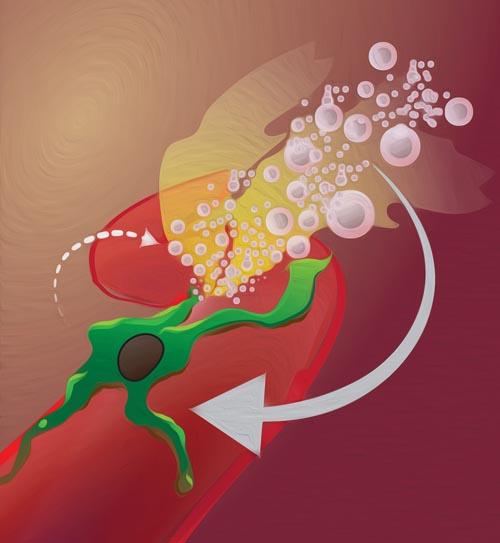 Macrophage-mediated Vascular Bursting