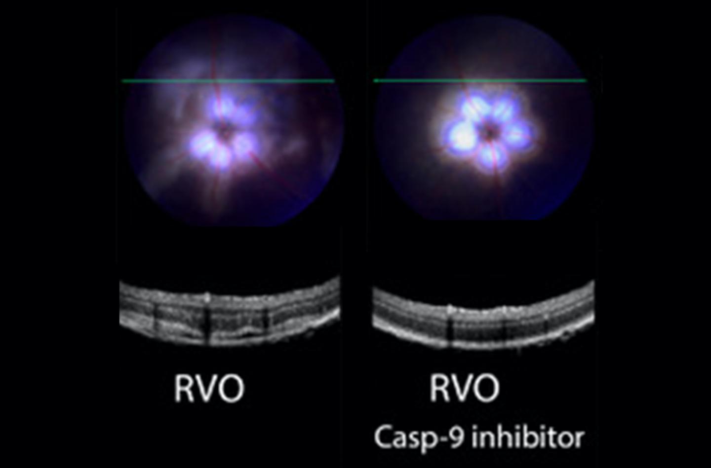 Caspase-9 inhibitor in retinal vein occlusion