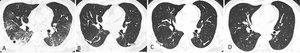 Chest CT Shows Lung Abnormalities Two Years after COVID