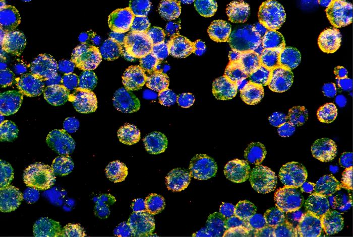 Discovery Finds How Ovarian Cancer Disables Immune Cells