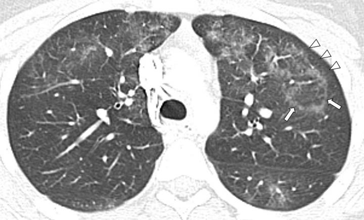 Study Looks at  EVALI Findings in Teens (1 of 3)