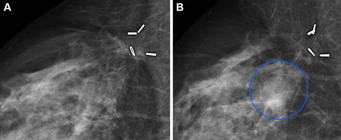 Full-field digital mammograms (right mediolateral oblique view)