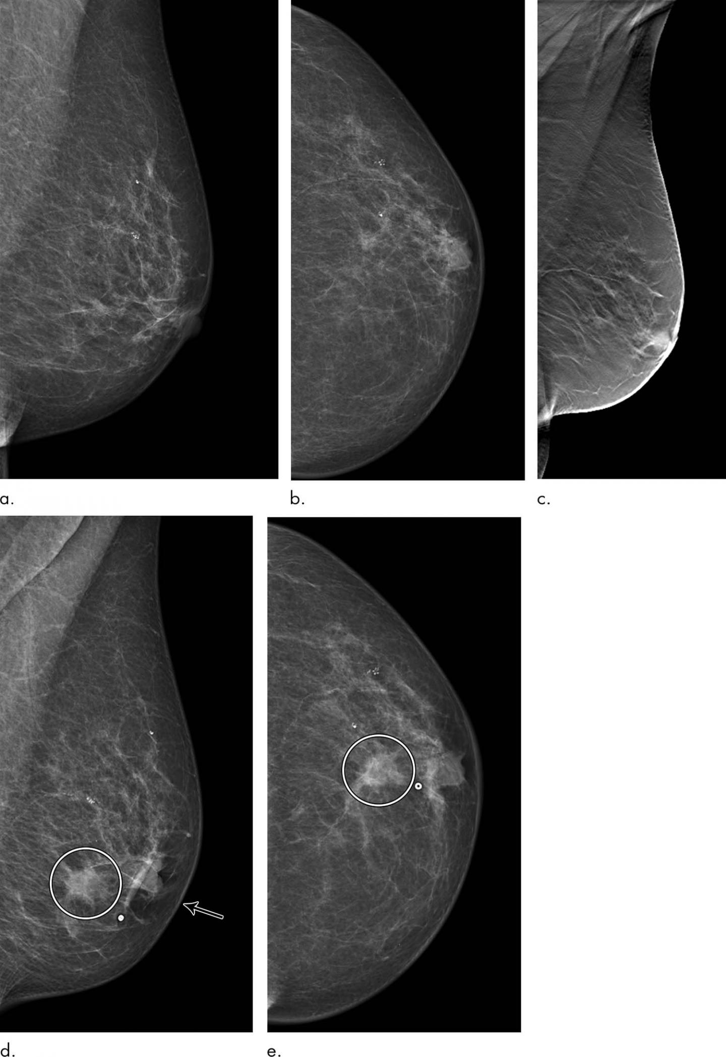 breast cancer digital mammogram