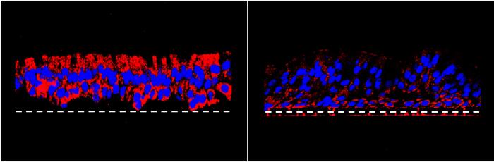 Cystic fibrosis: why infections persist despite therapy