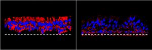 Cystic fibrosis: why infections persist despite therapy