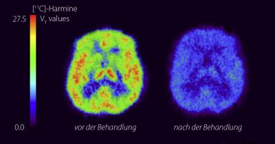 Depression from Monoamine-Oxidase A