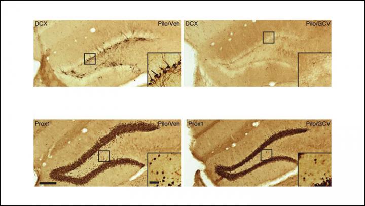 Reducing Seizures by Removing Newborn Neurons