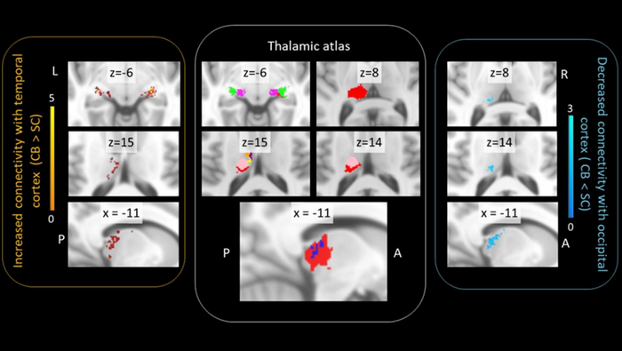 Thalamocortical Connectivity Changes in Congenitally Blind Individuals