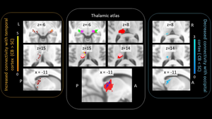 Thalamocortical Connectivity Changes in Congenitally Blind Individuals