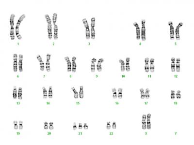 Karyotype of the Twin with Trisomy 21