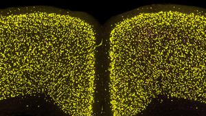 Lewy pathology in neurons