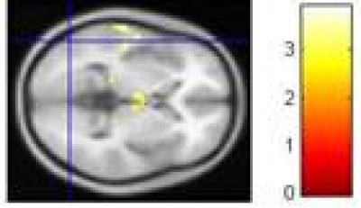 Functional MRI of Brain