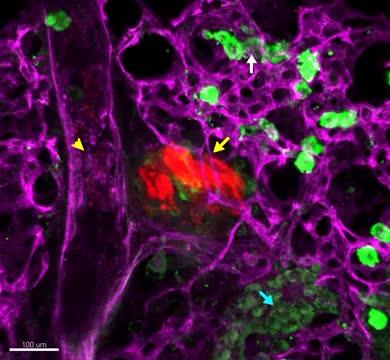 Two-Phased Clot Clearance Method May Hinder and Help (7 of 7)