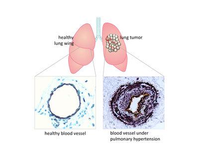 Hypertension Associated with Lung Cancer