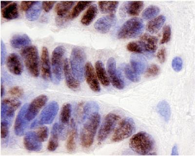 PAX8 in Ovarian Cancer Cells