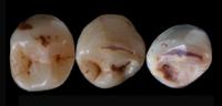 Ancient Teeth Found in Israel